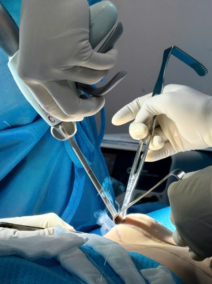Hợp đồng Capsular là gì?